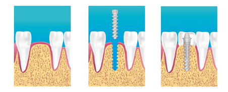 implant dentaire villiers sur marne